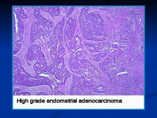    I. Surface mullerian epithelial tumors: (Benign,
    Borderline, and Malignant)
   1-Serous tumors: composed of cilia...