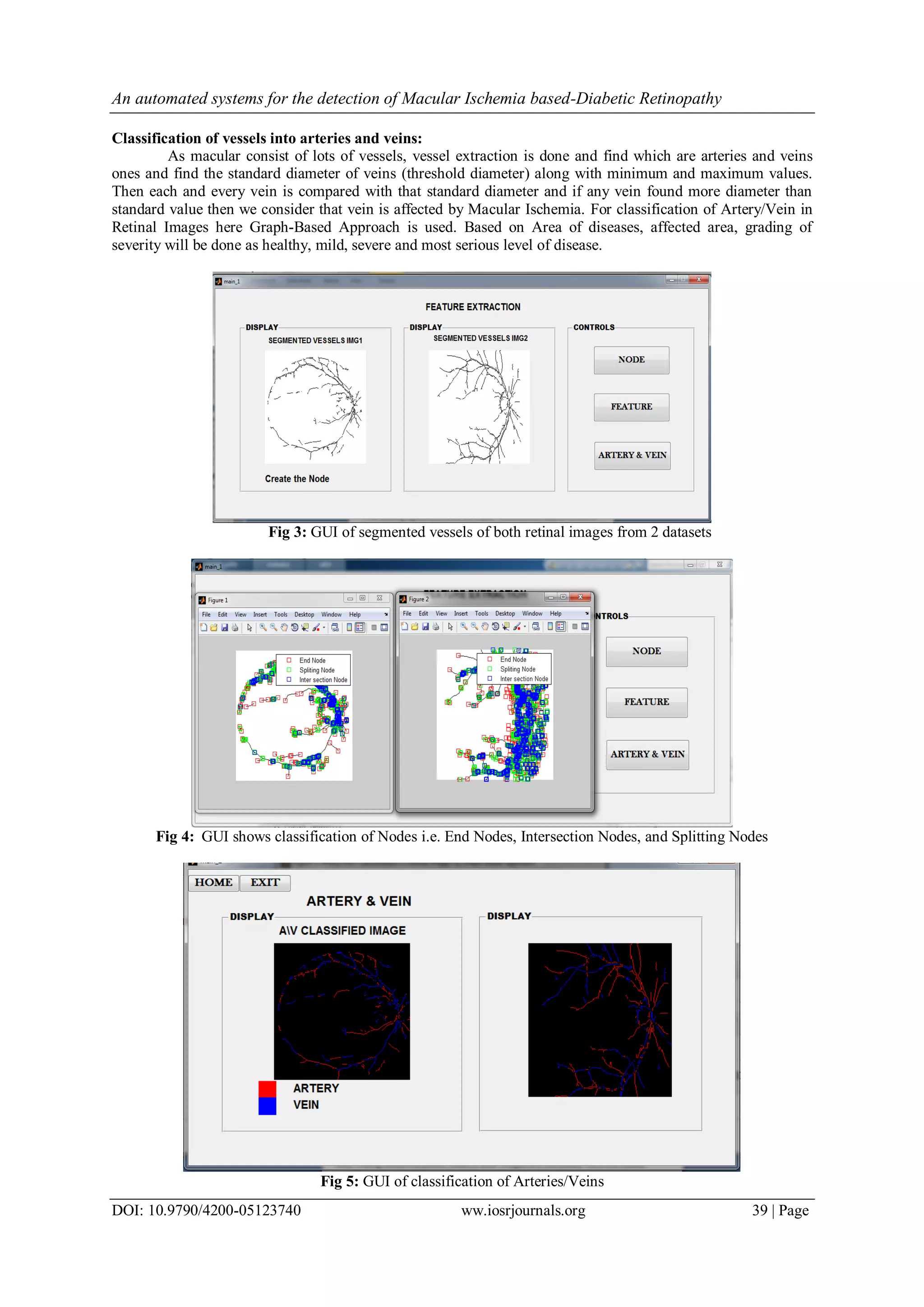 An automated systems for the detection of Macular Ischemia based-Diabetic Retinopathy
DOI: 10.9790/4200-05123740 ww.iosrjournals.org 39 | Page
Classification of vessels into arteries and veins:
As macular consist of lots of vessels, vessel extraction is done and find which are arteries and veins
ones and find the standard diameter of veins (threshold diameter) along with minimum and maximum values.
Then each and every vein is compared with that standard diameter and if any vein found more diameter than
standard value then we consider that vein is affected by Macular Ischemia. For classification of Artery/Vein in
Retinal Images here Graph-Based Approach is used. Based on Area of diseases, affected area, grading of
severity will be done as healthy, mild, severe and most serious level of disease.
Fig 3: GUI of segmented vessels of both retinal images from 2 datasets
Fig 4: GUI shows classification of Nodes i.e. End Nodes, Intersection Nodes, and Splitting Nodes
Fig 5: GUI of classification of Arteries/Veins
 