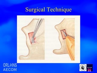 Surgical Technique 