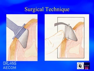 Surgical Technique 