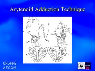 Arytenoid Adduction Technique 