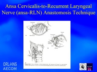 Ansa Cervicalis-to-Recurrent Laryngeal Nerve (ansa-RLN) Anastomosis Technique 