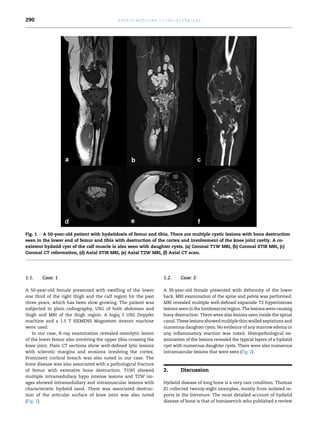 1.1. Case: 1
A 50-year-old female presented with swelling of the lower
one third of the right thigh and the calf region for the past
three years, which has been slow growing. The patient was
subjected to plain radiography, USG of both abdomen and
thigh and MRI of the thigh region. A logiq 3 USG Doppler
machine and a 1.5 T SIEMENS Magnetom Avanto machine
were used.
In our case, X-ray examination revealed osteolytic lesion
of the lower femur also involving the upper tibia crossing the
knee joint. Plain CT sections show well-deﬁned lytic lesions
with sclerotic margins and erosions involving the cortex.
Prominent cortical breach was also noted in our case. The
bone disease was also associated with a pathological fracture
of femur with extensive bone destruction. T1WI showed
multiple intramedullary hypo intense lesions and T2W im-
ages showed intramedullary and intramuscular lesions with
characteristic hydatid sand. There was associated destruc-
tion of the articular surface of knee joint was also noted
(Fig. 1).
1.2. Case: 2
A 30-year-old female presented with deformity of the lower
back. MRI examination of the spine and pelvis was performed.
MRI revealed multiple well-deﬁned expansile T2 hyperintense
lesionsseenin the lumbosacral region. Thelesions were causing
bony destruction. There were also lesions seen inside the spinal
canal. These lesions showedmultiple thinwalled septations and
numerous daughter cysts. No evidence of any marrow edema or
any inﬂammatory reaction was noted. Histopathological ex-
amination of the lesions revealed the typical layers of a hydatid
cyst with numerous daughter cysts. There were also numerous
intramuscular lesions that were seen (Fig. 2).
2. Discussion
Hydatid disease of long bone is a very rare condition. Thomas
JD collected twenty-eight examples, mostly from isolated re-
ports in the literature. The most detailed account of hydatid
disease of bone is that of Ivanissevich who published a review
Fig. 1 e A 50-year-old patient with hydatidosis of femur and tibia. There are multiple cystic lesions with bone destruction
seen in the lower end of femur and tibia with destruction of the cortex and involvement of the knee joint cavity. A co-
existent hydatid cyst of the calf muscle is also seen with daughter cysts. (a) Coronal T1W MRI, (b) Coronal STIR MRI, (c)
Coronal CT reformation, (d) Axial STIR MRI, (e) Axial T2W MRI, (f) Axial CT scan.
a p o l l o m e d i c i n e 1 0 ( 2 0 1 3 ) 2 8 9 e2 9 2290
 