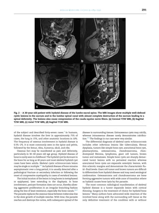 of the subject and described forty-seven cases.3
In humans,
hydatid disease involves the liver in approximately 75% of
cases, the lung in 15%, and other anatomic locations in 10%.
The frequency of osseous involvement in hydatid disease is
0.5%e2%. It is most commonly seen in the spine and pelvis,
followed by the femur, tibia, humerus, skull, and ribs.
Osseous foci may be manifested as pain and deformity,
particularly in 30e60 years old age group. Hydatid disease of
bone is rarely seen inchildhood. The hydatid cyst liedormant in
the bone for as long as 40 years and most skeletal hydatid cyst
cases have been adults. Skeletal cystic echinococcosis lesion
may be single or multiple.4,5
As hydatid disease of bone remains
asymptomatic over a long-period, it is usually detected after a
pathological fracture or secondary infection or following the
onset of compressive myelopathy in cases of vertebral lesions.
The initial location of the lesion in long bones is metaphyseal
or epiphyseal, later extending to the diaphysis. In bone
involvement, pericyst formation does not occur, thereby allow-
ing aggressive proliferation in an irregular branching fashion
along the line of least resistance, especially the bone canals.3,6,7
The parasite replaces the osseoustissue between trabeculae due
to the slow growth of multiple vesicles. With time, the parasite
reaches and destroys the cortex, with subsequent spread of the
disease to surrounding tissues. Extraosseous cysts may calcify,
whereas intraosseous disease rarely demonstrates calciﬁca-
tion.2,5
The ﬁndings in our case were very similar.
The differential diagnosis of skeletal cystic echinococcosis
includes other infectious lesions like tuberculosis, ﬁbrous
dysplasia, tumors like simple bone cyst, aneurismal bone cyst,
plasmacytoma, osteosarcoma, chondrosarcoma, chon-
dromyxoid ﬁbroma, lymphoma, giant cell tumors, brown
tumor and metastases. Simple bone cysts are sharply demar-
cated lucent lesions with no periosteal reaction whereas
aneurismal bone cysts are expansile osteolytic lesions, with
thin sclerotic margins and demonstrate the characteristic ﬂu-
ideﬂuid levels. Giant cell tumor and brown tumors are difﬁcult
to differentiate from hydatid disease and may need serological
conﬁrmation. Osteosarcoma and chondrosarcoma are bone
forming aggressive tumors with wide zone of transition where
as hydatid causes bone lysis by the parasite.
The most common radiological manifestation of skeletal
hydatid disease is a lucent expansile lesion with cortical
thinning. Surgery is the treatment of choice for hydatid bone
lesions.8
Many authors have advocated wide resection of the
involved bone along with the surrounding soft tissue as the
only deﬁnitive treatment of the condition with or without
Fig. 2 e A 30-year-old patient with hydatid disease of the lumbo-sacral spine. The MRI images show multiple well-deﬁned
cystic lesions in the sacrum and in the lumbar spinal canal with almost complete destruction of the sacrum leading to a
spinal deformity. The lesions also cause compression of the cauda equine nerve ﬁbers. (a) Coronal T2W MRI, (b) Sagittal
T2W MRI, (c) Axial T1W MRI, (d) Sagittal T1W MRI.
a p o l l o m e d i c i n e 1 0 ( 2 0 1 3 ) 2 8 9 e2 9 2 291
 