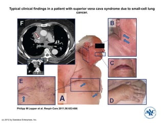 Typical clinical findings in a patient with superior vena cava syndrome due to small-cell lung
cancer.
Philipp M Lepper et al. Respir Care 2011;56:653-666
(c) 2012 by Daedalus Enterprises, Inc.
 