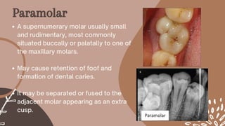 A supernumerary molar usually small
and rudimentary, most commonly
situated buccally or palatally to one of
the maxillary molars.
May cause retention of foof and
formation of dental caries.
It may be separated or fused to the
adjacent molar appearing as an extra
cusp.
Paramolar
 