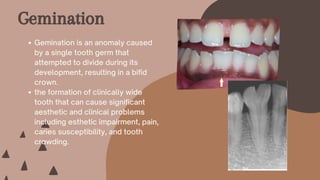 Gemination is an anomaly caused
by a single tooth germ that
attempted to divide during its
development, resulting in a bifid
crown.
the formation of clinically wide
tooth that can cause significant
aesthetic and clinical problems
including esthetic impairment, pain,
caries susceptibility, and tooth
crowding.
Gemination
 
