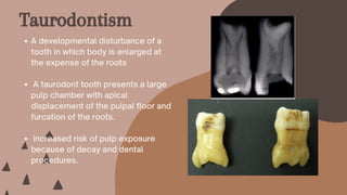 A developmental disturbance of a
tooth in which body is enlarged at
the expense of the roots
A taurodont tooth presents a large
pulp chamber with apical
displacement of the pulpal floor and
furcation of the roots.
increased risk of pulp exposure
because of decay and dental
procedures.
Taurodontism
 
