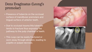 Presence of tubercle on the occlusal
surface of mandibular premolars and
lingual surface of anterior teeth.
Due to occlusal trauma this tubercle
tends to fracture thus exposing the
pathway to the pulp chamber of teeth.
This cusp can be easily fractured or
worn away through abrasion, leading to
pulpitis or pulpal necrosis.
Dens Evaginatus (Leong's
premolar)
 