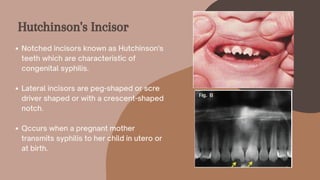 Notched incisors known as Hutchinson's
teeth which are characteristic of
congenital syphilis.
Lateral incisors are peg-shaped or scre
driver shaped or with a crescent-shaped
notch.
Qccurs when a pregnant mother
transmits syphilis to her child in utero or
at birth.
Hutchinson's Incisor
 