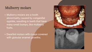 Mulberry molars are a tooth
abnormality caused by congenital
syphilis, resulting in teeth that have
many small bumps, like mulberry
fruits.
Dwarfed molars with cusps covered
with globular enamel growths.
Mulberry molars
 