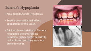 Also called Enamel Hypoplasia
Teeth abnormality that affect
appearance of the teeth.
Clinical characteristics of Turner's
hypoplasia are unfavorable
esthetics, higher dentin sensitivity,
malocclusion and they are more
prone to caries.
Turner's Hypoplasia
 