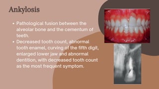 Pathological fusion between the
alveolar bone and the cementum of
teeth.
Decreased tooth count, abnormal
tooth enamel, curving of the fifth digit,
enlarged lower jaw and abnormal
dentition, with decreased tooth count
as the most frequent symptom.
Ankylosis
 
