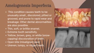 Amelogenesis Imperfecta
This condition causes teeth to be
unusually small , discolored, pitted or
grooved, and prone to rapid wear and
breakage. Other dental abnormalities
are also possible.
Thin, soft, or brittle enamel.
Extreme tooth sensitivity.
Yellow, brown, grey, or white (snow-
capping) discoloration of teeth.
Open bite (misaligned jaws)
Uneven, lumpy, or ridged teeth.
 