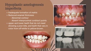 Hypoplastic amelogenesis
imperfecta
Inadequate formation of matrix
Reduced enamel thickness
Abnormal contour
Absent interproximal conbtact points
upper and lower teeth that do not meet
showing a poor bite, and teeth that vary in
color from off-white to yellow-brown.
 