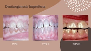 TYPE II


TYPE I TYPE III
Dentinogenesis Imperfecta
 