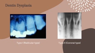 Type II (Coronal type)
Type I (Radicular type)
Dentin Dysplasia
 
