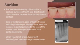 The mechanical wearing of the incisal or
occlusal surfaces of teeth as a direct result
of functional or parafunctional tooth-to-tooth
contact.
Sore or tender gums. Loss of teeth structure
including flattening or thinning of the teeth. An
increase in dental pain due to the loss of the
enamel layer. Damage or failure of prior
dental treatments.
When you clench or grind your teeth
(bruxism) your teeth will begin to wear down.
Attrition
 