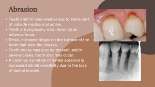 Teeth start to lose enamel due to some sort
of outside mechanical action.
Teeth are physically worn down by an
external force.
Small, v-shaped ridges on the surface of the
teeth that face the cheeks.
Tooth decay may also be present, and in
severe cases, tooth loss may occur.
A common symptom of dental abrasion is
increased dental sensitivity due to the loss
of dental enamel.
Abrasion
 