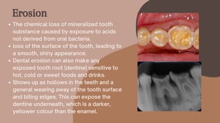 The chemical loss of mineralized tooth
substance caused by exposure to acids
not derived from oral bacteria.
loss of the surface of the tooth, leading to
a smooth, shiny appearance.
Dental erosion can also make any
exposed tooth root (dentine) sensitive to
hot, cold or sweet foods and drinks.
Shows up as hollows in the teeth and a
general wearing away of the tooth surface
and biting edges. This can expose the
dentine underneath, which is a darker,
yellower colour than the enamel.
Erosion
 