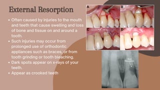 Often caused by injuries to the mouth
and teeth that cause swelling and loss
of bone and tissue on and around a
tooth.
Such injuries may occur from
prolonged use of orthodontic
appliances such as braces, or from
tooth grinding or tooth bleaching.
Dark spots appear on x-rays of your
teeth.
Appear as crooked teeth
External Resorption
 