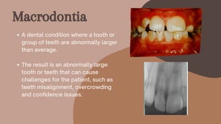 Macrodontia
A dental condition where a tooth or
group of teeth are abnormally larger
than average.
The result is an abnormally large
tooth or teeth that can cause
challenges for the patient, such as
teeth misalignment, overcrowding
and confidence issues.
 