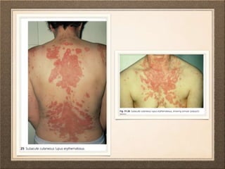 Dermatological manifestation of systemic diseases | PPTX