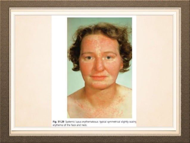 Dermatological manifestation of systemic diseases | PPTX