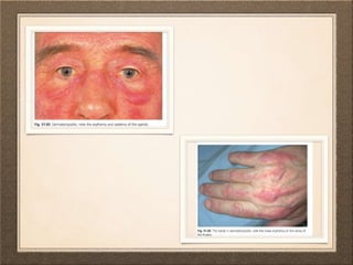 Systemically Unwell Rash Dermatological manifestation of systemic diseases | PPTX