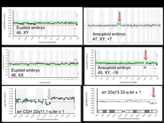 Euploid embryo
46, XY

Euploid embryo
46, XX

Aneuploid embryo
47, XY, +7

Aneuploid embryo
45, XY, -16

arr 20q13.32-q.ter x 1

arr CGH 22q11.1-q.ter x 1
27

 