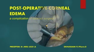POST-OPERATIVE-CORNEAL
EDEMA
a complication of cataract surgery
PRECEPTOR: Dr (MRS) UZZI I.A OKHUOSAMI F.S Pharm.D
 