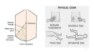 Comprehensive Overview of Acute Abdomen: Appendicitis and Peritonitis ...