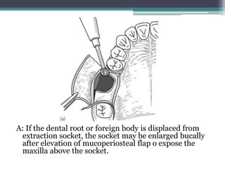 A: If the dental root or foreign body is displaced from
extraction socket, the socket may be enlarged bucally
after elevation of mucoperiosteal flap o expose the
maxilla above the socket.
 