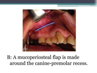 B: A mucoperiosteal flap is made
around the canine-premolar recess.
 