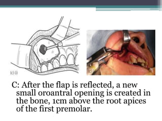 C: After the flap is reflected, a new
small oroantral opening is created in
the bone, 1cm above the root apices
of the first premolar.
 