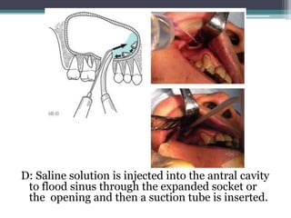 D: Saline solution is injected into the antral cavity
to flood sinus through the expanded socket or
the opening and then a suction tube is inserted.
 