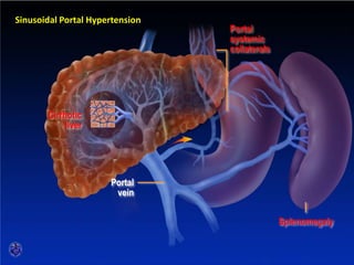 SINUSOIDAL PORTAL HYPERTENSION
Cirrhotic
liver
Portal
vein
Sinusoidal Portal Hypertension
Portal
systemic
collaterals
Splenomegaly
 
