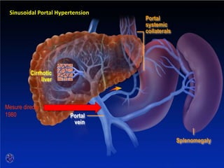 SINUSOIDAL PORTAL HYPERTENSION
Cirrhotic
liver
Portal
vein
Sinusoidal Portal Hypertension
Portal
systemic
collaterals
Splenomegaly
Mesure directe
1980
 