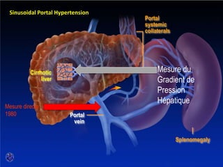 SINUSOIDAL PORTAL HYPERTENSION
Cirrhotic
liver
Portal
vein
Sinusoidal Portal Hypertension
Portal
systemic
collaterals
Splenomegaly
Mesure directe
1980
Mesure du
Gradient de
Pression
Hépatique
 