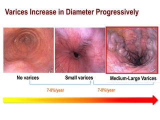 Small varices Large varicesNo varices
7-8%/year 7-8%/year
Varices Increase in Diameter Progressively
Medium-Large Varices
 