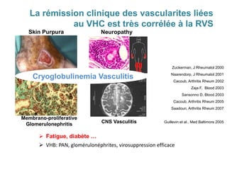 La rémission clinique des vascularites liées
au VHC est très corrélée à la RVS
Zuckerman, J Rheumatol 2000
Naarendorp, J Rheumatol 2001
Cacoub, Arthritis Rheum 2002
Zaja F, Blood 2003
Sansonno D, Blood 2003
Cacoub, Arthritis Rheum 2005
Saadoun, Arthritis Rheum 2007
Guillevin et al., Med Baltimore 2005
Skin Purpura
Membrano-proliferative
Glomerulonephritis CNS Vasculitis
Neuropathy
Cryoglobulinemia Vasculitis
 Fatigue, diabète …
 VHB: PAN, glomérulonéphrites, virosuppression efficace
 