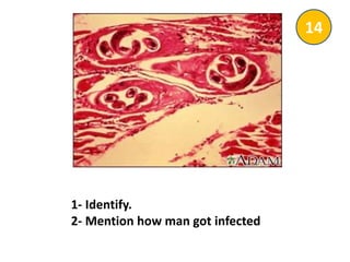 1- Identify.
2- Mention how man got infected
14
 