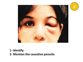 1- Identify.
2- Mention the causative parasite
6
 