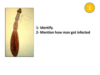 1- Identify.
2- Mention how man got infected
1
 