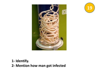 1- Identify.
2- Mention how man got infected
19
 