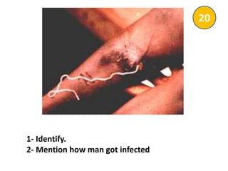 1- Identify.
2- Mention how man got infected
20
 