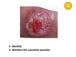 1- Identify.
2- Mention the causative parasite
2
 
