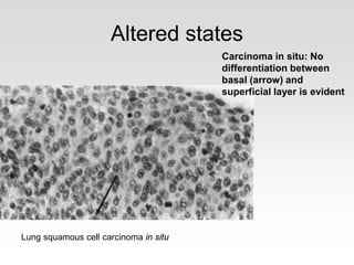 Altered states
Carcinoma in situ: No
differentiation between
basal (arrow) and
superficial layer is evident
Lung squamous cell carcinoma in situ
 