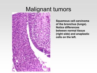 Malignant tumors
Squamous cell carcinoma
of the bronchus (lungs).
Notice differences
between normal tissue
(right side) and anaplastic
cells on the left.
 