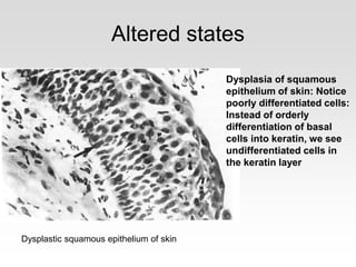 Altered states
Dysplasia of squamous
epithelium of skin: Notice
poorly differentiated cells:
Instead of orderly
differentiation of basal
cells into keratin, we see
undifferentiated cells in
the keratin layer
Dysplastic squamous epithelium of skin
 
